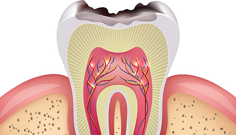 「歯の根を残す」根管治療