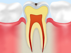 初期の虫歯【CO】