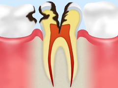 神経の虫歯【C3】
