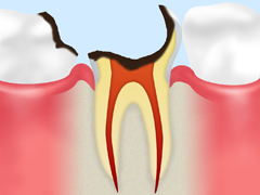 歯根の虫歯【C4】