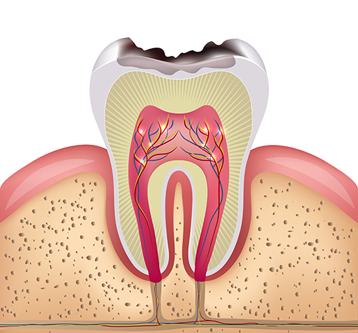 歯の根を残す「根管治療」