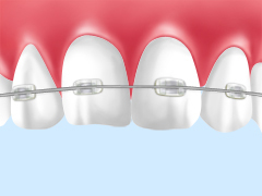 セラミックブラケット～目立ちにくいブラケット
