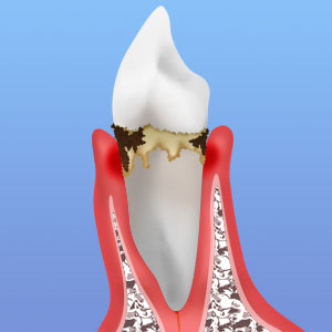 初期歯周炎