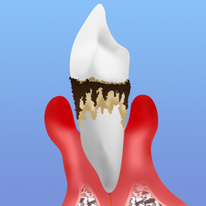 末期歯周炎