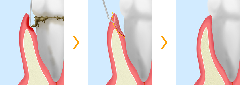 歯周ポケットそうは術