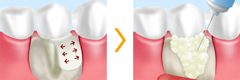 歯周組織再生療法